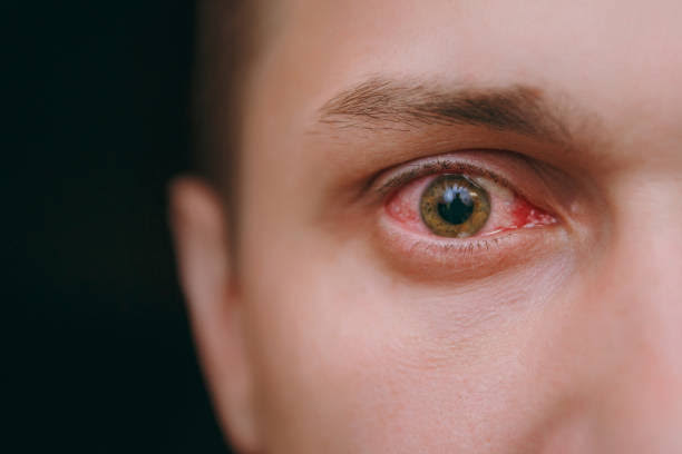 Eye Flu Overview
