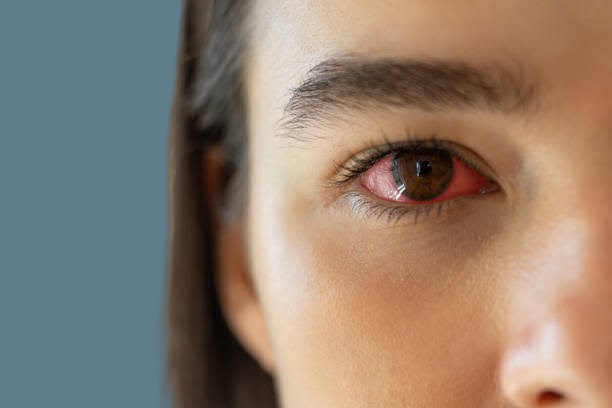 Eye Flu Symptoms
